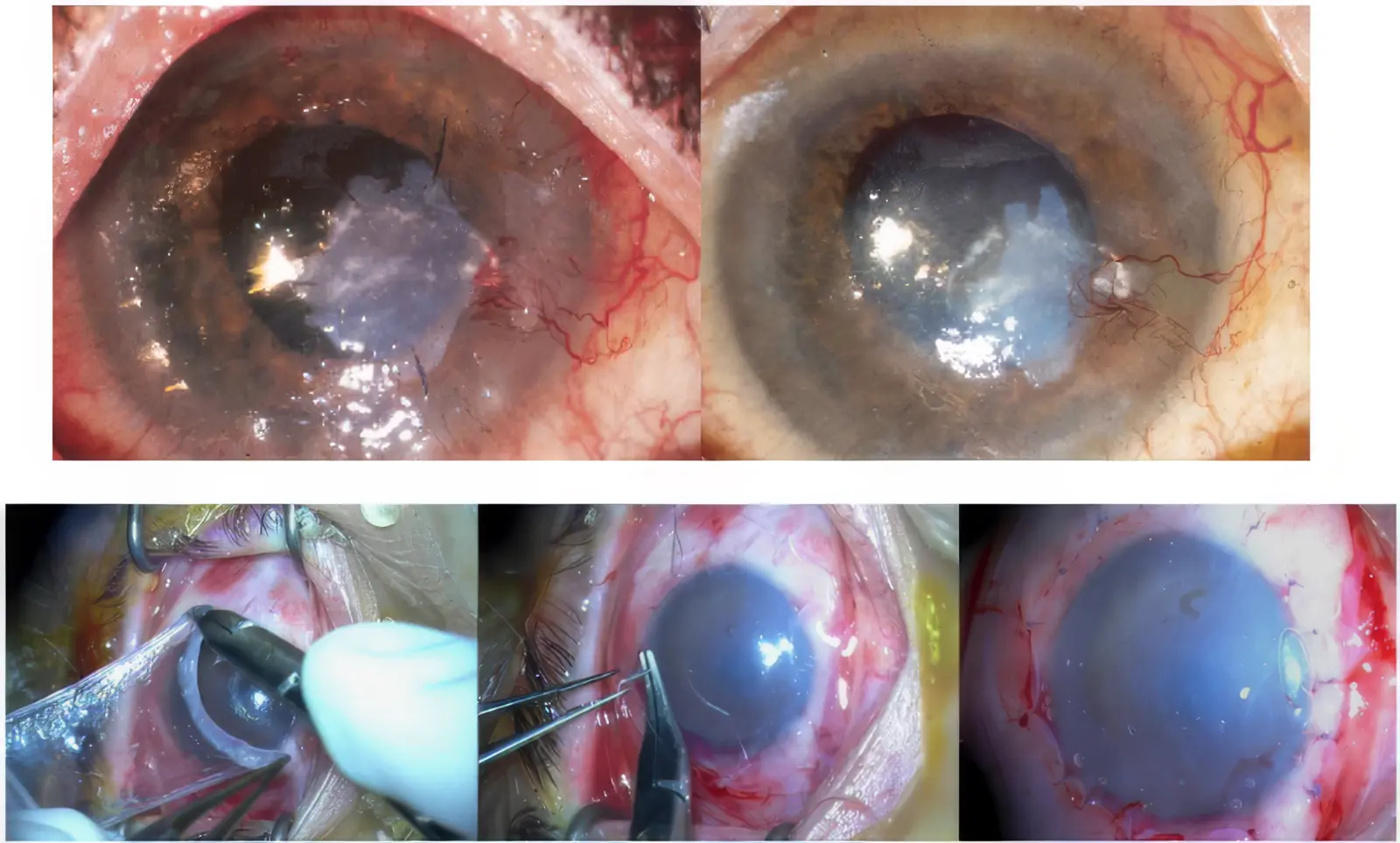 Amniotic membrane transplantation in severe ocular surface disease