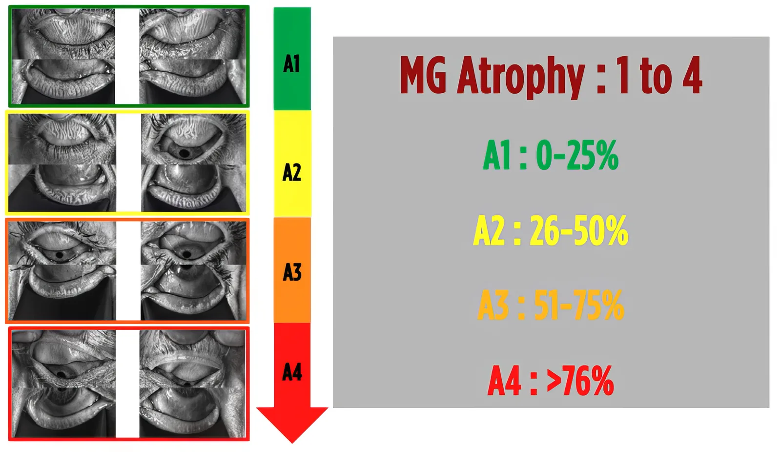 WIDES four-stage grading of meibomian gland atrophy on infrared meibography, from preserved glands to advanced dropout