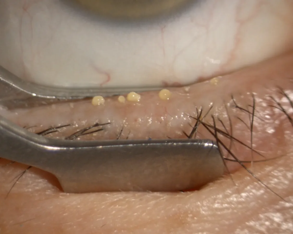 Forceps-assisted expression of the meibomian glands under the slit lamp, with meibum visible at the gland orifices