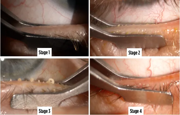 WIDES four-stage grading of meibomian gland obstruction: four close-up photographs of forceps-assisted expression, Stage 1 to Stage 4