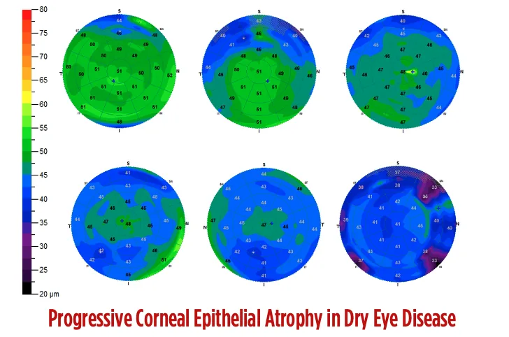 Six corneal epithelial pachymetry maps showing progressive epithelial atrophy in dry eye disease