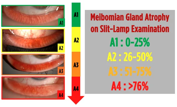 Everted eyelids under the slit lamp showing meibomian gland atrophy graded from A1 to A4