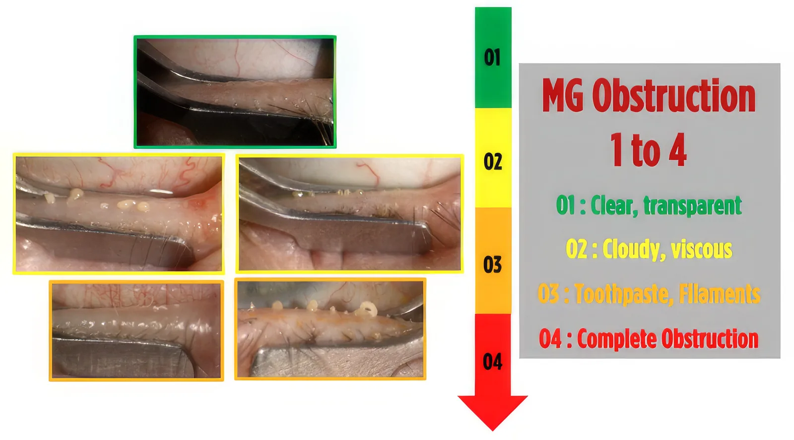Lid margins under the slit lamp showing meibomian gland orifice obstruction graded from O1 to O4