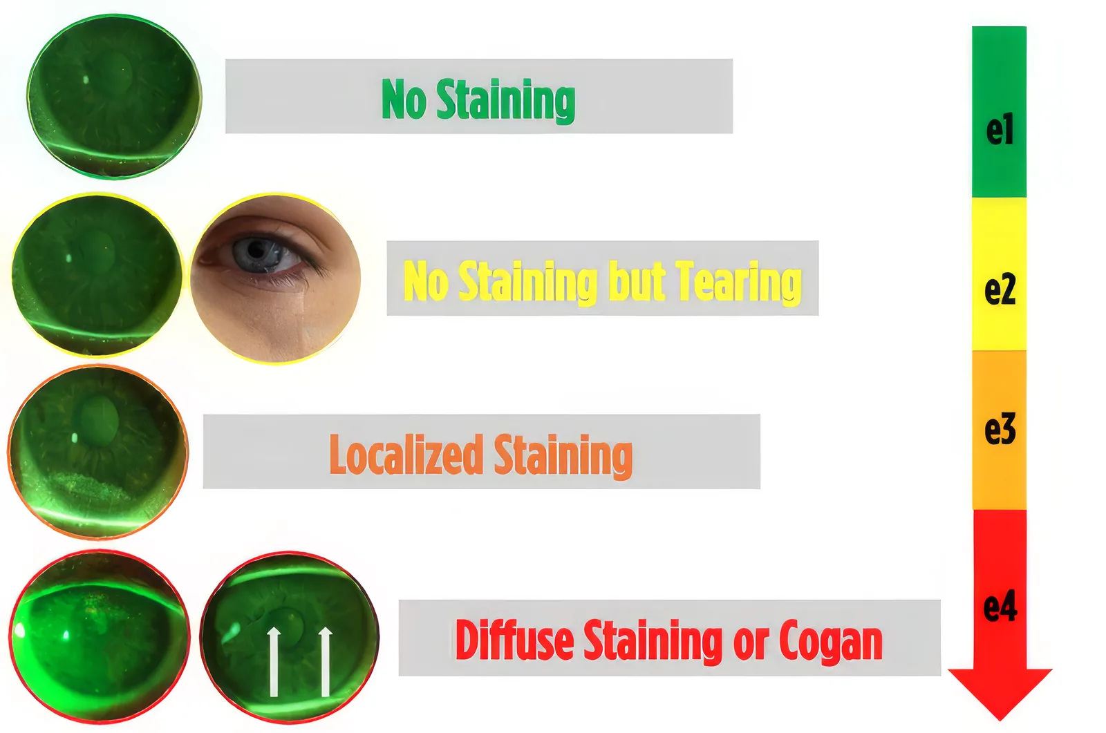 Slit-lamp photographs of corneal fluorescein staining graded from e1 to e4 on the WIDES scale