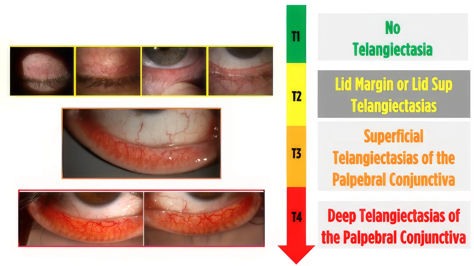 Lid margins under the slit lamp showing telangiectatic involvement graded from T1 to T4
