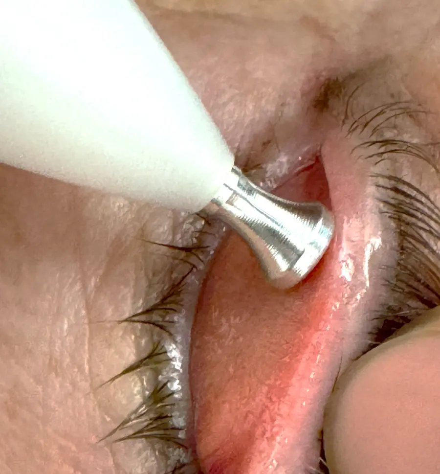 Radiofrequency handpiece applied to the lower eyelid margin