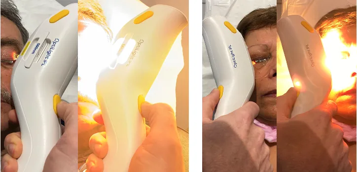 Four clinical views of IPL treatment of the upper and lower periocular regions with an ophthalmic handpiece