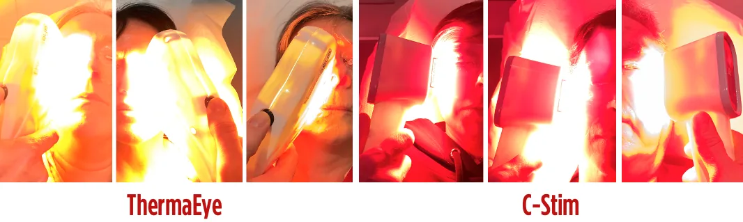 Six clinical views of periorbital IPL treatment with ThermaEye and C-Stim handpieces around the lower eyelids