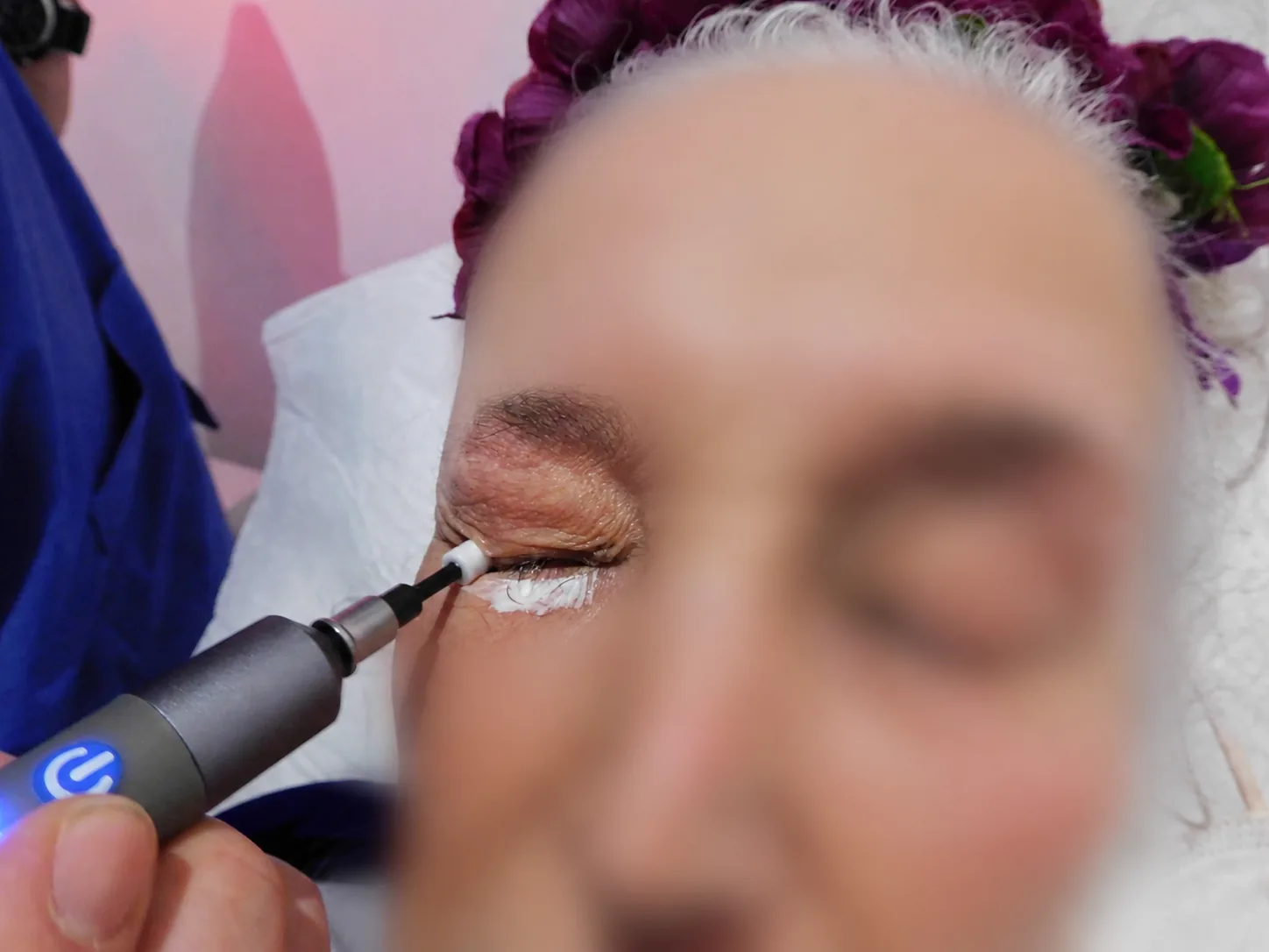 Lid margin debridement performed along the base of the eyelashes