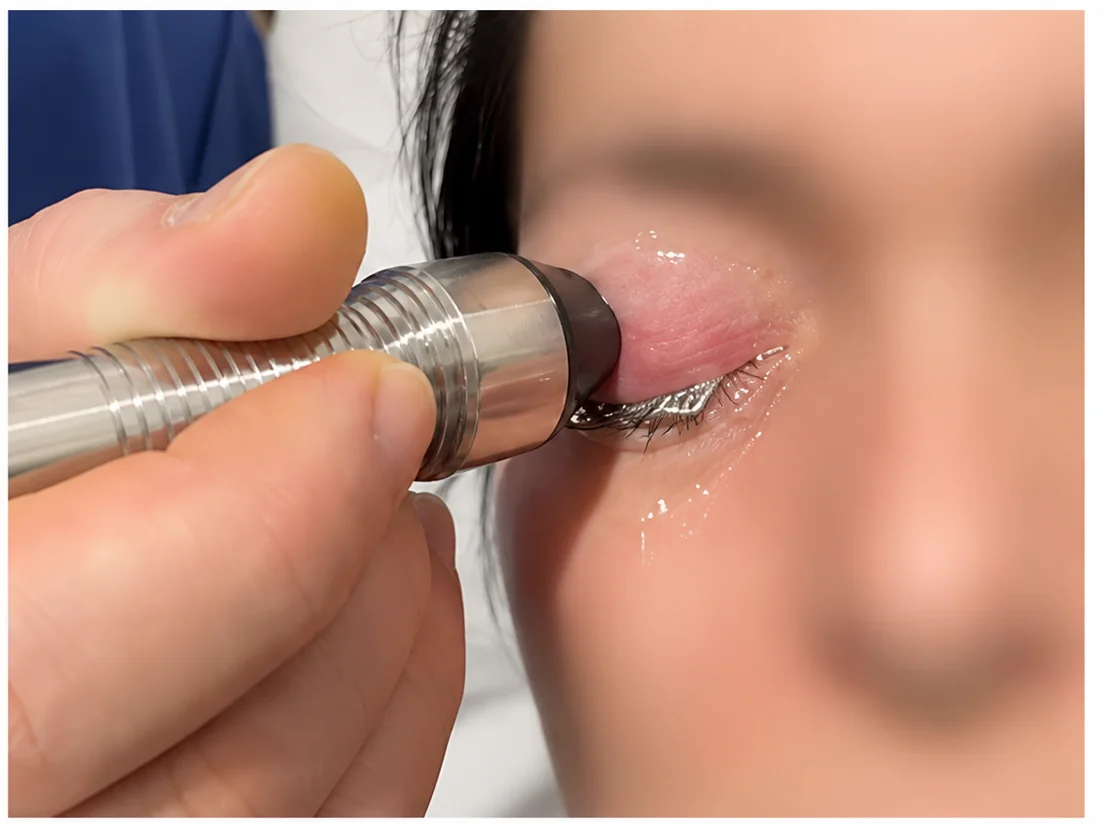 Radiofrequency handpiece applied to the periocular region during treatment