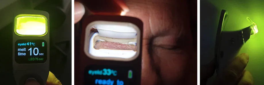 iLux handheld thermal pulsation system: device screen, eyelid seen through the applicator, and the handheld device in use