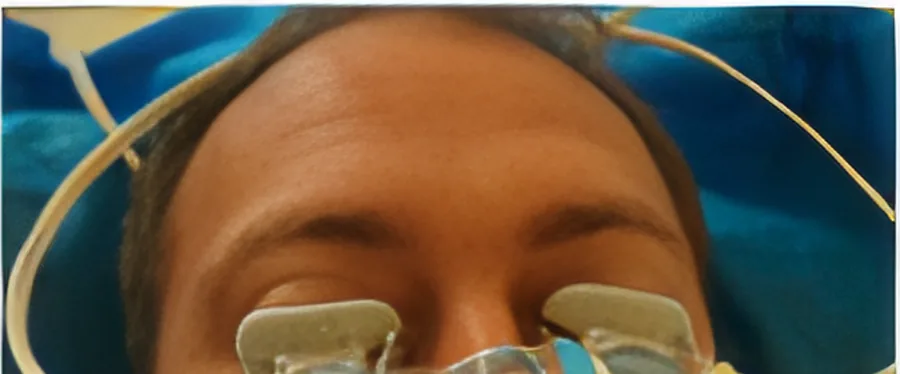 LipiFlow activators in place on both eyes