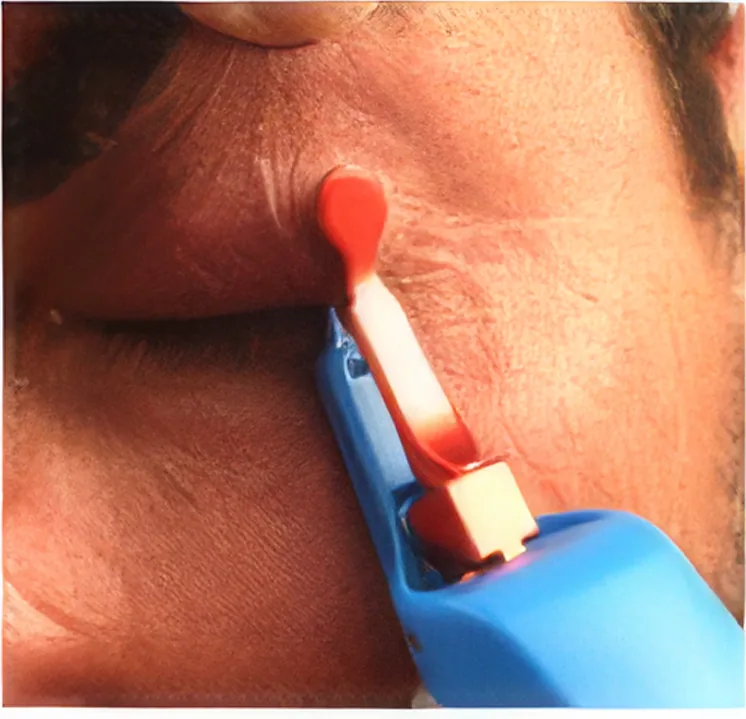 MGrX thermal device applied to the eyelid