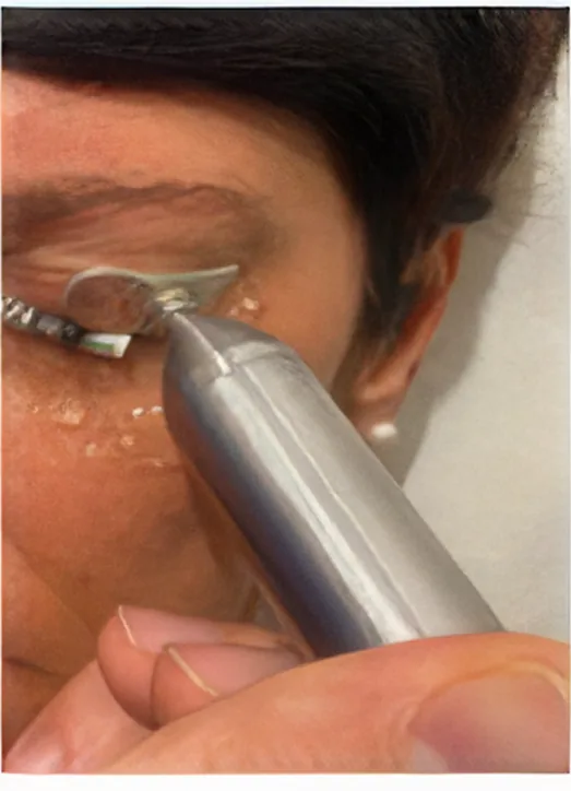 MiBo Flo probe applied along the lid margin