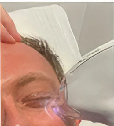 Tixel applicator positioned on the eyelid