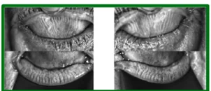 Meibography with preserved glands, four eyelids
