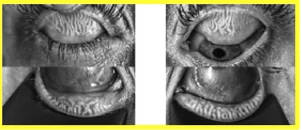 Meibography with moderate gland loss