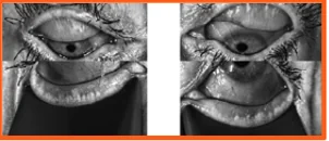 Meibography with marked gland loss