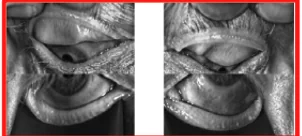 Meibography with advanced gland dropout