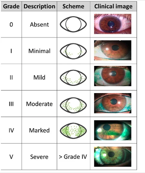 Oxford grading scale of corneal staining, grades 0 to V, with schematic and clinical images