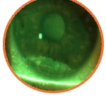 Localized inferior corneal staining