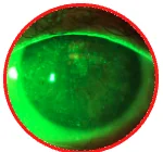 Diffuse corneal staining
