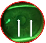 Cogan-like epitheliopathy with arrows marking epithelial lesions