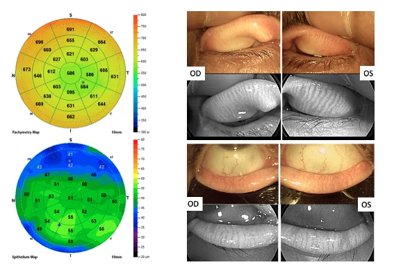 eTAO Expert assessment: corneal pachymetry and epithelial maps, eyelid photographs and four-eyelid meibography of both eyes