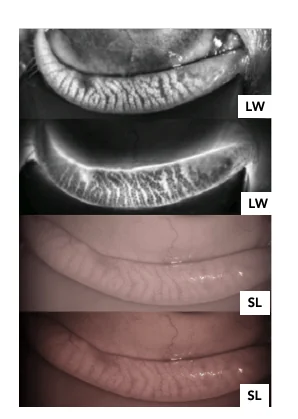 Lower eyelid: two infrared meibography views and two slit-lamp views of the same eyelid