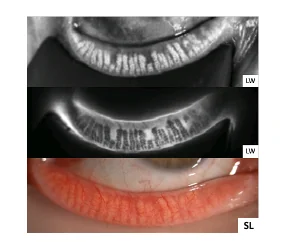Lower eyelid: two infrared meibography views and one slit-lamp view of the everted eyelid