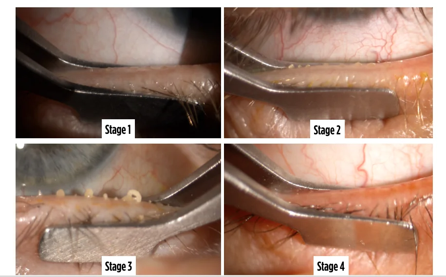 Four stages of meibomian gland obstruction seen during gland expression, from stage 1 to stage 4