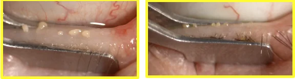Gland expression with cloudy, viscous meibum, two views