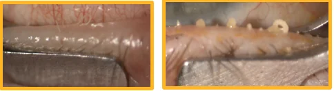 Gland expression with thick, toothpaste-like or filamentous meibum, two views