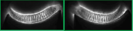 Meibography of eyelids without telangiectasia