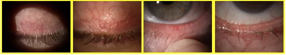 Lid margin and upper eyelid telangiectasia, four clinical views