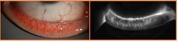 Superficial telangiectasia of the palpebral conjunctiva with corresponding meibography