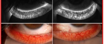 Deep telangiectasia of the palpebral conjunctiva with corresponding meibography
